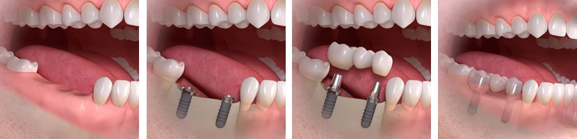 implantes-puente-fijo-clinica-dental