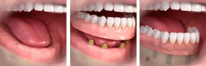 implantes-removibles2-clinica-dental